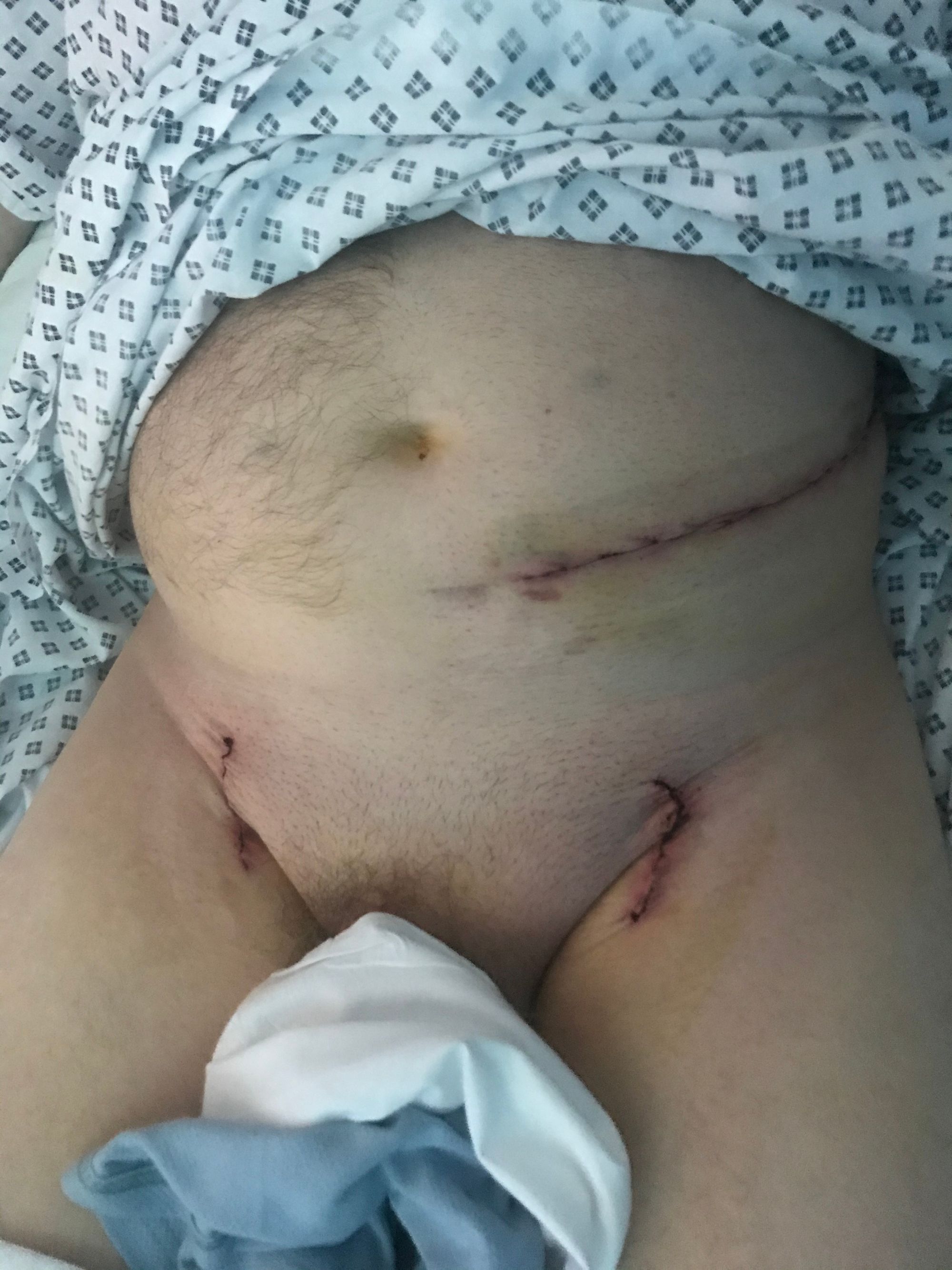 Lower Limb Salvage, successful Aorta bifemoral bypass via left retroperitoneal approach combined with regional anaesthesia.