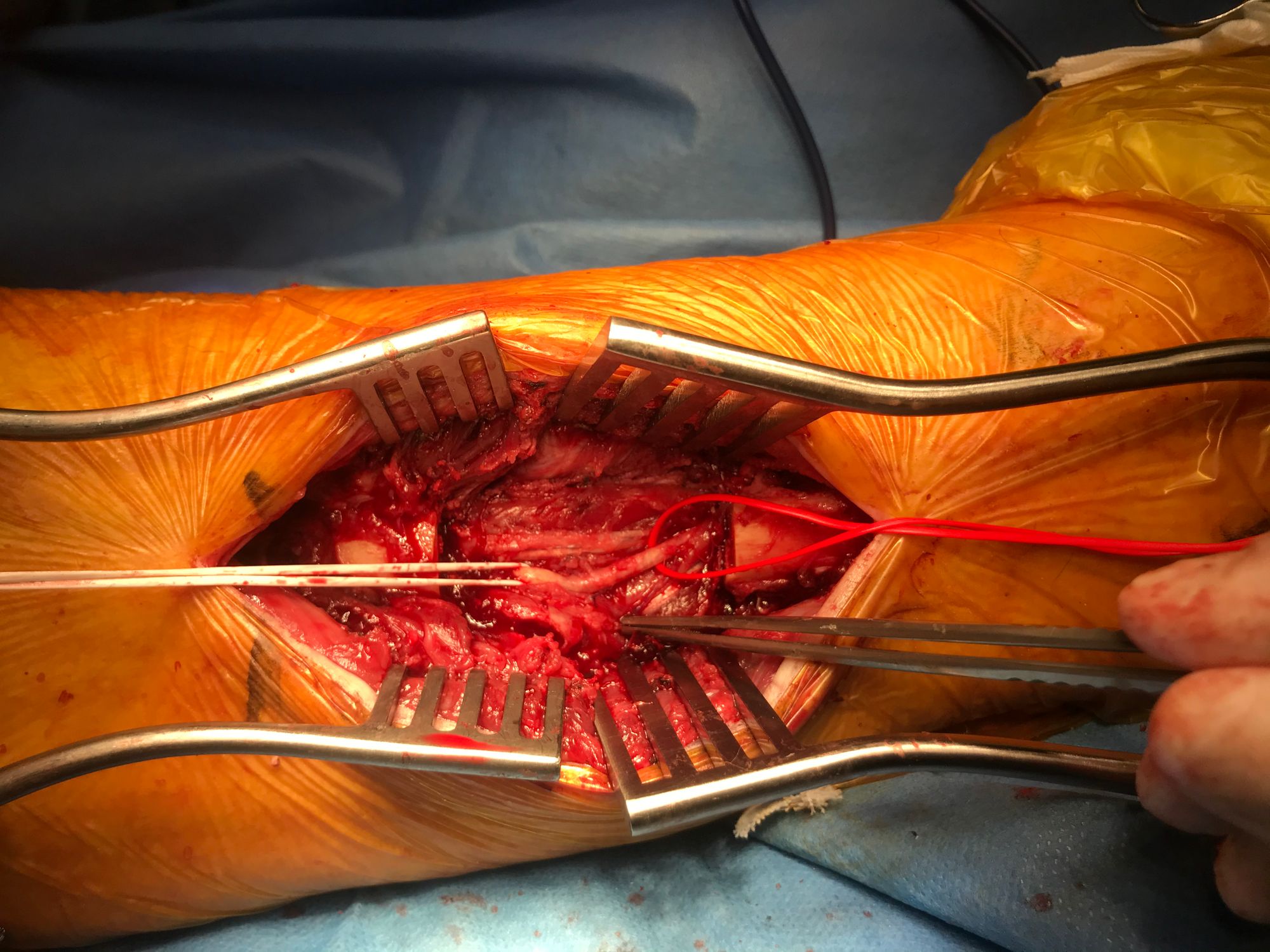 Lower limb salvage after failed  Angioplasty, a Successful Femoral to Peroneal Bypass via a lateral approach with partial fibula resection.
